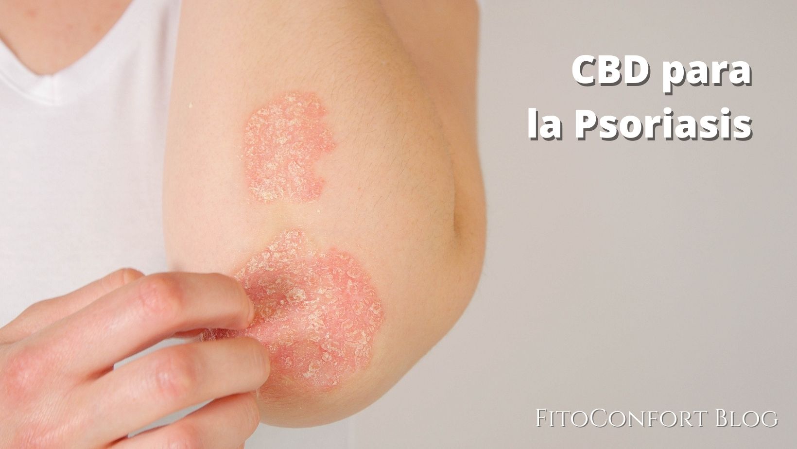 CBD para la psoriasis